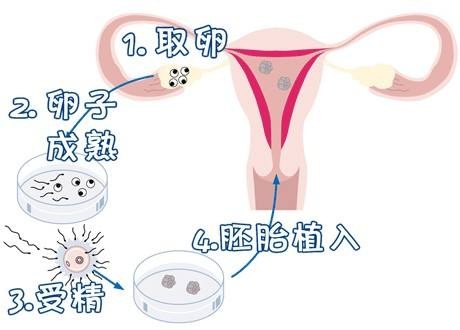 男性不妊